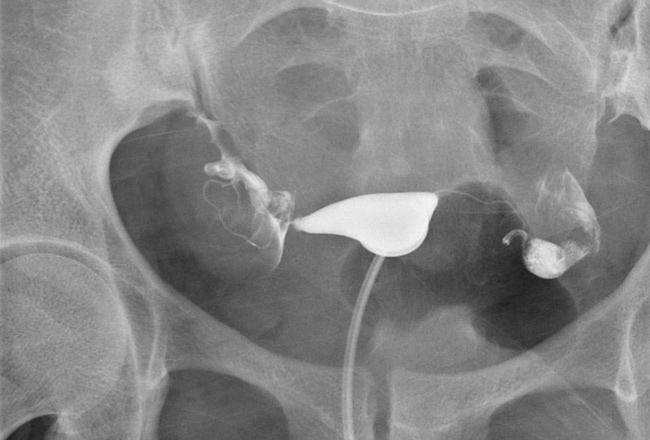 Sonohysterogram - MacArthur Medical Center