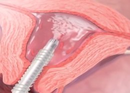 HTA Endometrial Ablation for Menorrhagia - MacArthur Medical Center
