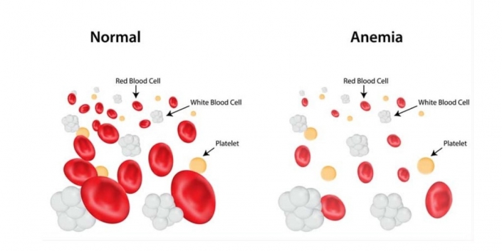 Iron-Deficiency Anemia; Why It Happens and What to Do About It ...