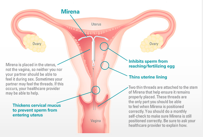 Mirena IUD - MacArthur Medical Center
